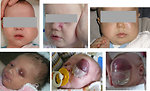 Figure 4: Head and neck sarcomas  (usually in children < 3 years)