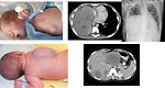 Figure 6: Sarcomas of the chest wall and abdomen