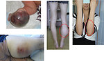 Figure 7: STS on the extremities