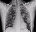Figure 8: Chest X-ray, metastatic synovial sarcoma to the lungs