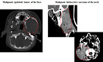 Figure 9: CT scan of the soft tissue sarcomas