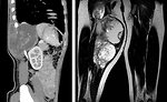 Figure 10: MRI of synovial sarcoma of the chest wall and extremity