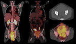 Figure 11: 18 FDG PET scan of urinary bladder alveolar rhabdomyosarcoma