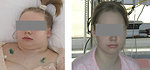 Figure 3: Clinical presentation of SVCS – edema of the head and neck