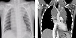 Figure 4: Chest X-ray and CT scan of mediastinal NHL