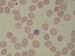 Gametocyte in a normocytic erytrocyte.
Erytrocytes: anisocytosis, anisochromia, ovalocytes, no Schuffner's dots.  / Gametocyt v nezvtenm erytrocytu.
Erytrocyty: anisocytosa, anisochromie, ovalocyty.
Nen vidt Schuffnerovo tekovn.