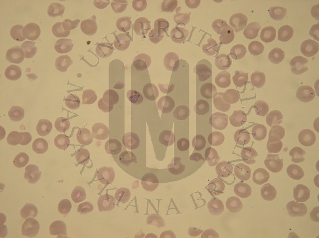 Plasmodium malariae (malaria quartana)