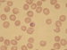 In no enlarged erytrocyte the dividing nucleus of parasite and pigment is present.
Erytrocytes: schistocytes can be found. / V nezvtenm erytrocytu dlc se jdro parazita s pigmentem.
Erytrocyty: mrn anisocytosa, anisochromie, schistocyty.i
