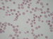 On the upper part of the picture are 8 sperocytes, on the lower part are noted 3 spherocytes.
Except spherocytes expressive anisocytosis and anisochromia  of erytrocytes and polychromasia can be seen. / V horn polovin obrzku se nachz 8 sfrocyt a v doln polovin 3 sfrocyty.
Mimo nlez sfrocyt je patrn vrazn anisocytosa  erytrocyt a polychromasie.