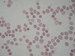 The next picture of the hereditary spherocytosis with expresiv anisocytosis and anisochromia of erytrocytes : spherocyte,mikrocytes, makrocytes, schistocytes,  tear drop-shaped  and polychromatic erytrocytes. / Dal obrzek hereditrn sfrocytosy s npadnou anisocytosou a anisochromi erytrocyt: sfrocyty, mikrocyty, makrocyty, schistocyty, polychromatick erytrocyty. 