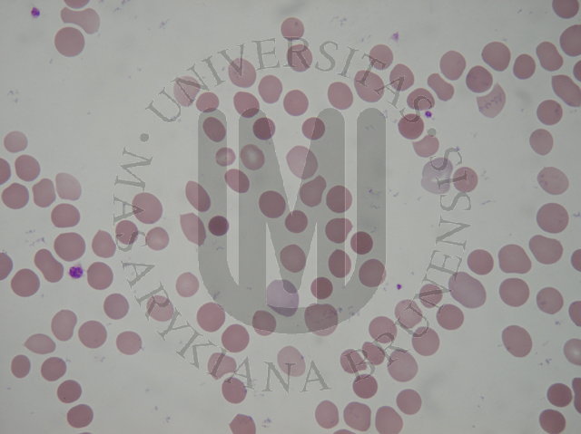 Spherocytosis