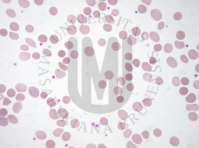 Spherocytosis -corrected