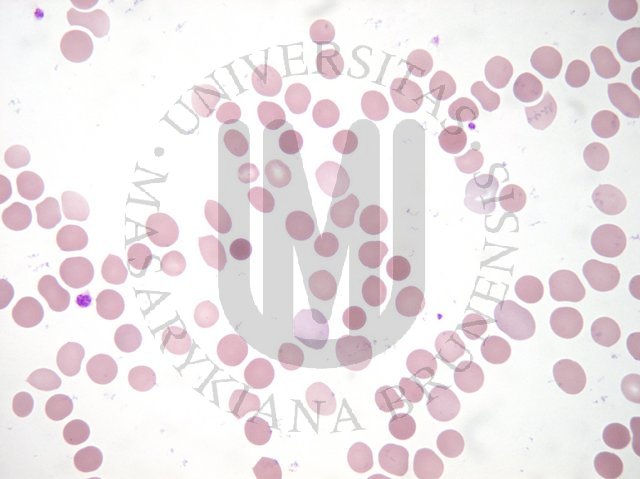 Spherocytosis -corrected