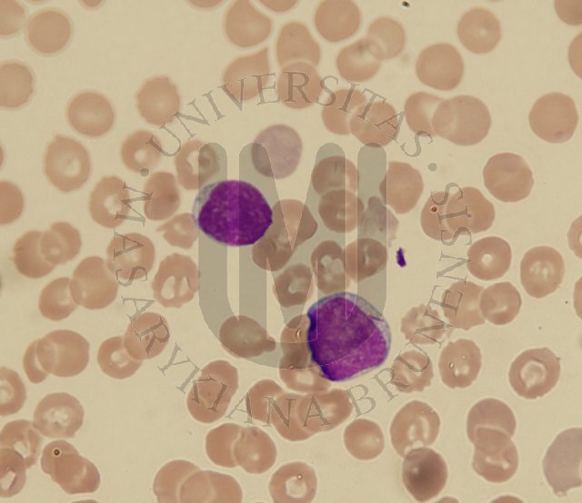 AML M2- perifern krev 1