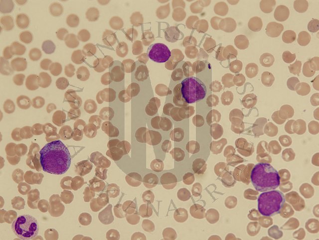 AML M2- perifern� krev 2