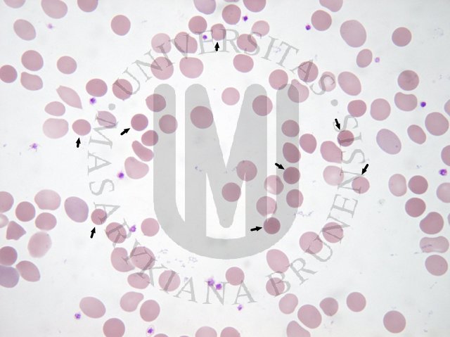 Spherocytosis -corrected