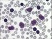 Small lymphocytes with mature nuclear chromatin, invisible nucleoli and scanty cytoplasm without granulation represent predominant population in bone marrow. The typical feature are also nuclear shadows.   / Mal lymfocyty se zralm jadernm chromatinem, nezetelnmi jadrky a chudou cytoplazmou bez granulace pedstavuj hlavn populaci kostn den. Typickm rysem jsou tak jadern stny. 