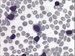 Peripheral blood smear shows small or medium size (upper left) lymphocytes with oval or round nuclei and clumped chromatin, scanty cytoplasm and a regular cellular outline. Cleft nucleus (underneath  the centre) is rare in this diagnose. Some prolymphocytes can occur (at the centre), they have prominent nucleolus and more abundant cytoplasm (4% of leukocytes in this case).  / Ntr perifern krve ukazuje mal nebo stedn velk (vlevo nahoe) lymfocyty s ovlnmi i kulatmi jdry a chomkovitm chromatinem, chudou cytoplazmou a pravidelnou zevn lini buky. Roztpen jdro (pod centrem) je u tto diagnzy vzcn. Me se objevit pr prolymfocyt (v centru), ty maj prominujc jadrka a vce objemnou cytoplazmu (v tomto ppad 4% leukocyt). 