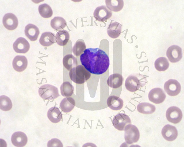 AML- perifern� krev