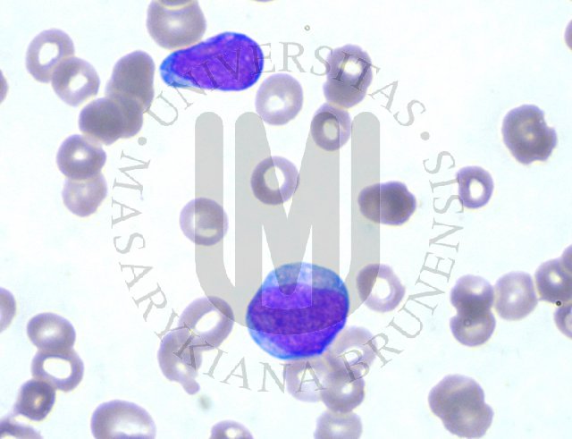 AML- perifern krev