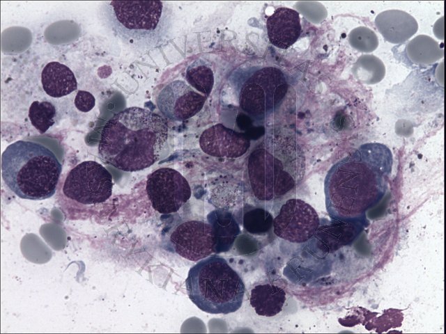 Megaloblastick hematopoza- KD