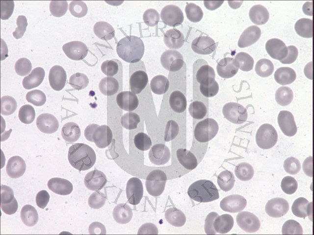 Megaloblastick hematopoza- PK